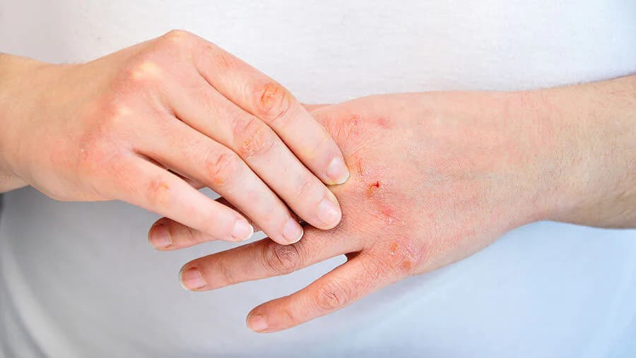 Was ist Psoriasis? Ein Leitfaden zu Symptomen und Behandlung