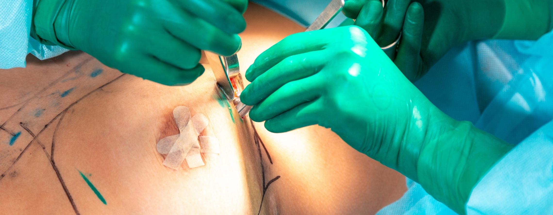 Brustvergrößerung mit Implantaten – Modernste Techniken für Ihr Wohlbefinden